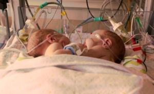 Conjoined twins Owen and Emmett Ezell before surgical separation. (Courtesy Reuters)