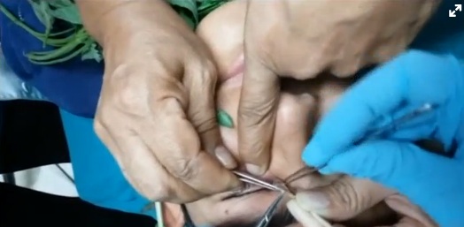 Doctors in Lima successfully use basil to lure three-centimetre (one inch) worm from 17-year-old boy's eye.  Reuters