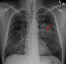 A chest X-ray showing a tumor in the lung (marked by arrow) (photo courtesy wikipedia.org)
