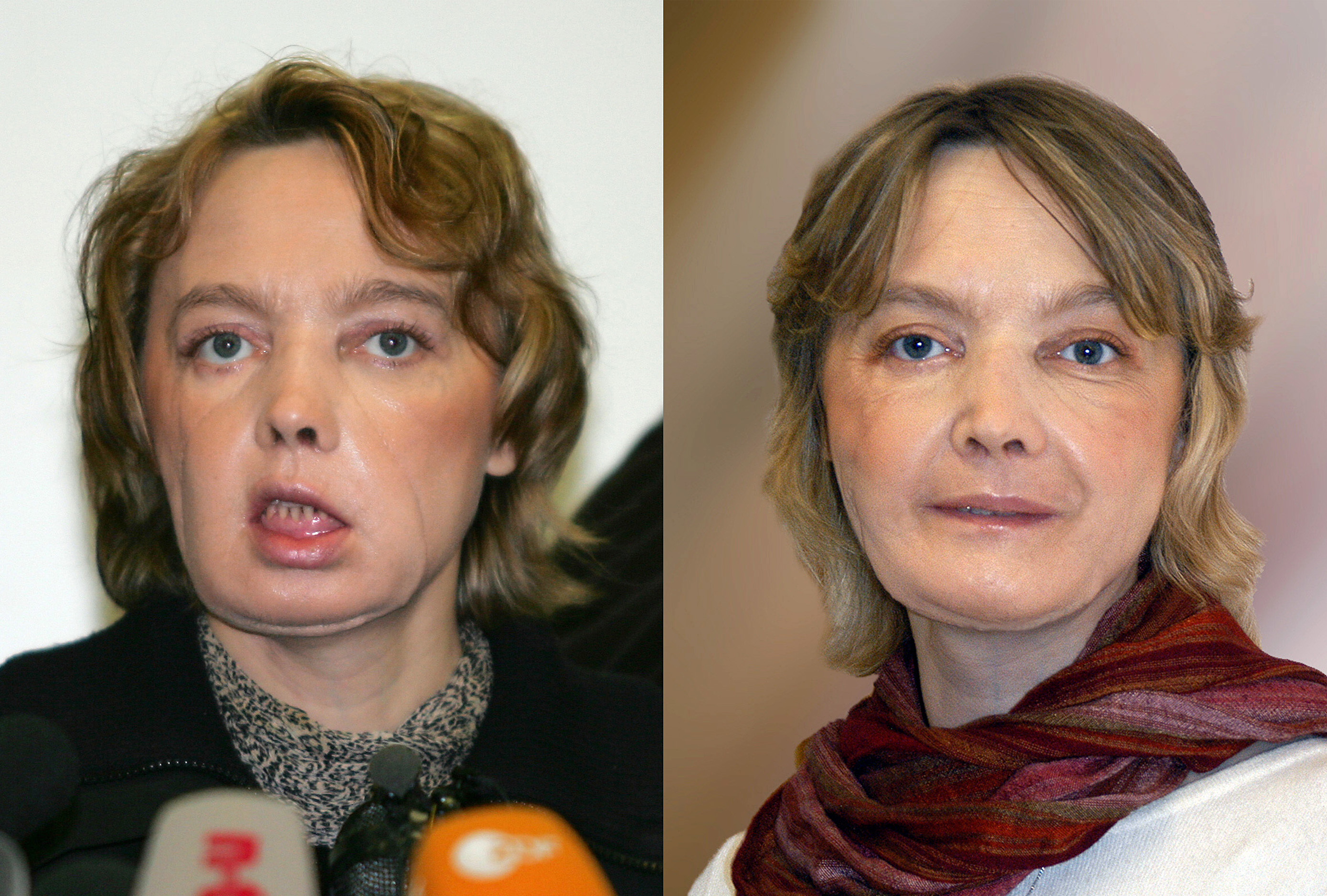 (FILES) This combination of pictures (dated, (L) February 6, 2006 and (R)from November 2006) of French Isabelle Dinoire, 39, a few months after her surgery operation carried out jointly by an Amiens and Lyon team who underwent the world's first facial face transplant, and a year later.  Isabelle Dinoire, who in 2005 at the age of 38 became the first recipient of a face transplant, died following a long illness on April 22, 2016it was announced by the CHU hospital in Amiens on September 6, 2016, in reports confirmed by French newspaper Le Figaro.   / AFP PHOTO / AFP & CHU AMIENS / DENIS CHARLET