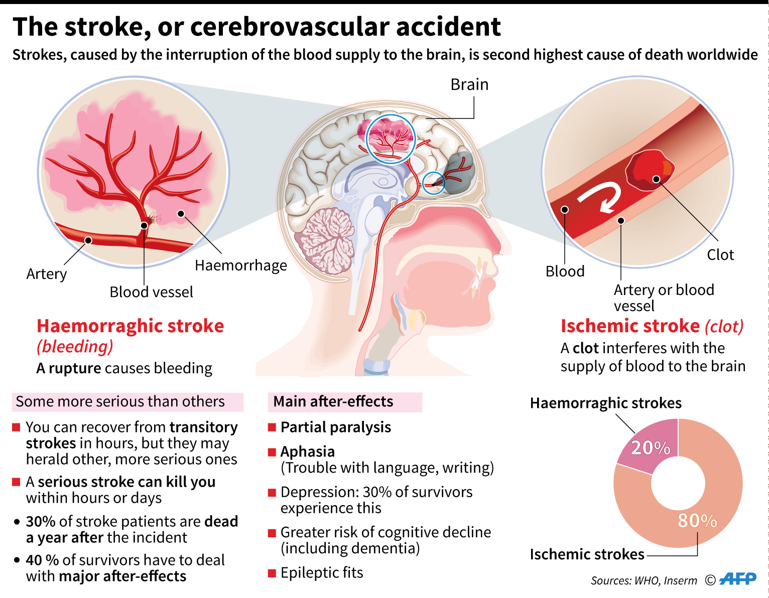 The stroke, or cerebrovascular accident