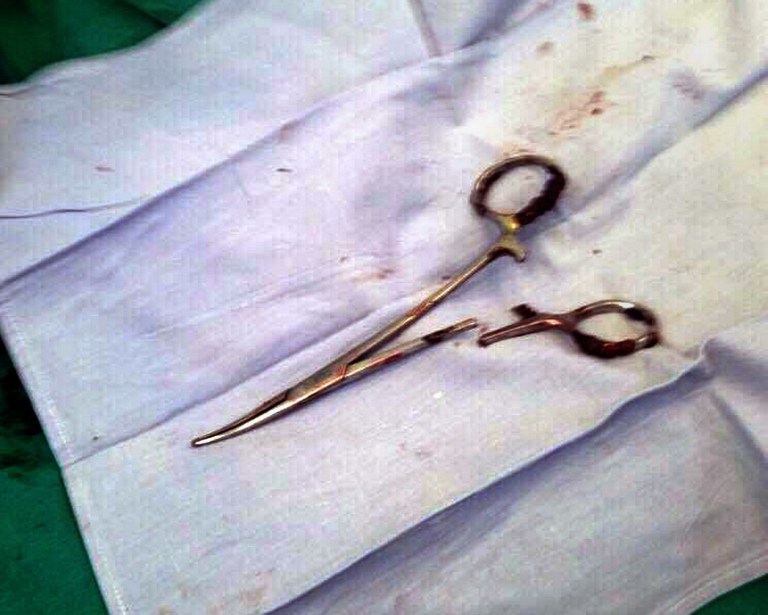 This picture taken on December 31, 2016 shows a pair of scissors which was removed from a patient's abdomen after being left behind during a surgery 18 years ago, at a clinic in the northern Vietnamese city of Thai Nguyen. Ma Van Nhat, now 54, underwent surgery in 1998 after a car accident and only recently discovered that doctors had left an unwelcome gift behind when they closed him up. / AFP PHOTO / Vietnam News Agency / VIETNAM NEWS AGENCY