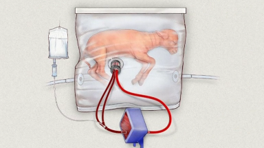 Scientists develop a fluid-filled womb-like bag known that could transform care for extremely premature babies. Photo grabbed from Reuters video file.
