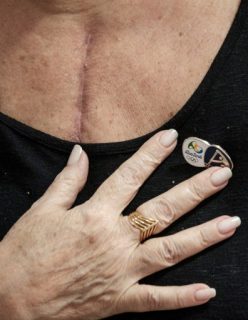 Ivonette Balthazar who received a heart transplant during the period of the Rio 2016 Olympic Games touches his chest, bearing the surgery scar and a "Rio 2016" pin, as she speaks to AFP at her home on November 25, 2016, in Rio de Janeiro, Brazil. Balthazar and her family believe the heart she received was donated by German national canoe coach Stefan Hence who died on a car accident in the first week of the Olympic games in Rio de Janeiro. / AFP PHOTO / YASUYOSHI CHIBA